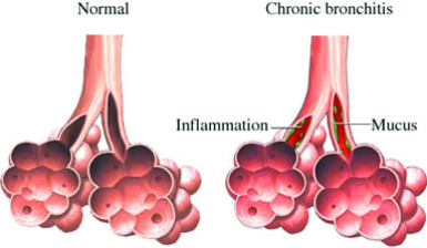 ciprofloxacin used for bronchitis