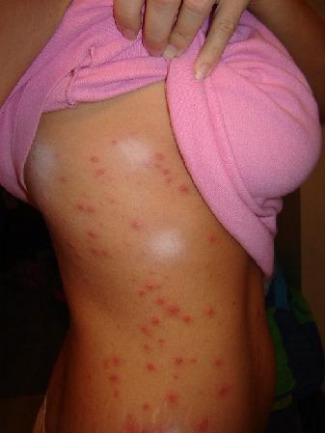Common Bacterial Skin Infections That Cause Rashes