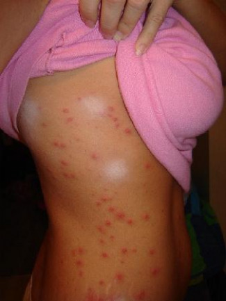 spa hot tubs
on Itchy Hot Tub Rash On Face & Hot Tub Folliculitis Pictures Of Rashes