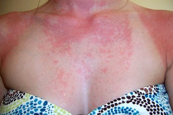 Image result for Sunscreen Allergy